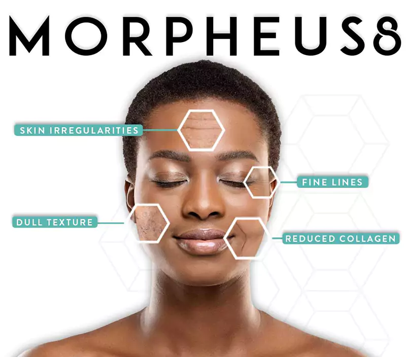 morpheus8-infographic-instagram-post-black-hair-preview-1-1-e1656722170113