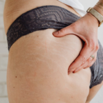 A woman noticing stretch marks on her hips