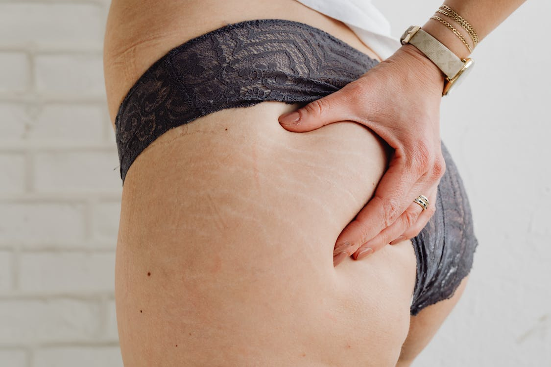 A woman noticing stretch marks on her hips