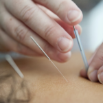 A person receiving an acupuncture treatment